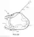 Fig. 42 - Treating dysfunctional cardiac tissue