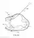 Fig. 43 - Treating dysfunctional cardiac tissue