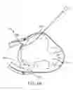 Fig. 44 - Treating dysfunctional cardiac tissue