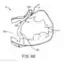 Fig. 45 - Treating dysfunctional cardiac tissue