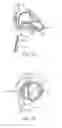 Fig. 49 - Treating dysfunctional cardiac tissue