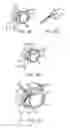 Fig. 55 - Treating dysfunctional cardiac tissue