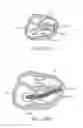 Fig. 69 - Treating dysfunctional cardiac tissue