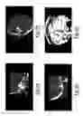 Fig. 05 - Tegmen plate prosthesis and methods for manufacturing and using the same