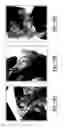 Fig. 16 - Tegmen plate prosthesis and methods for manufacturing and using the same