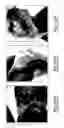 Fig. 17 - Tegmen plate prosthesis and methods for manufacturing and using the same