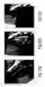 Fig. 19 - Tegmen plate prosthesis and methods for manufacturing and using the same