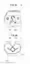 Fig. 03 - Artificial knee joint