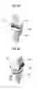 Fig. 06 - Artificial knee joint