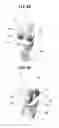 Fig. 07 - Artificial knee joint