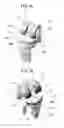 Fig. 08 - Artificial knee joint