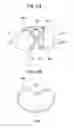 Fig. 12 - Artificial knee joint