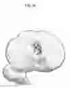 Fig. 20 - Artificial knee joint