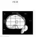 Fig. 33 - Artificial knee joint