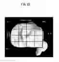 Fig. 34 - Artificial knee joint