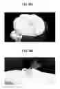 Fig. 37 - Artificial knee joint