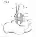 Fig. 07 - Systems and methods for installing ankle replacement prostheses