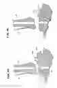 Fig. 09 - Systems and methods for installing ankle replacement prostheses