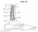 Fig. 12 - Systems and methods for installing ankle replacement prostheses