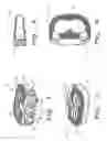 Fig. 02 - Intervertebral fusion implant