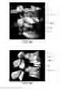 Fig. 17 - PLATE CAGE SYSTEM WITH STANDALONE EFFECTS AND RELATED METHODS