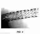 Fig. 03 - Bidirectional stent and method of use thereof