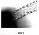 Fig. 05 - Bidirectional stent and method of use thereof