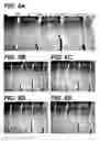 Fig. 08 - Bidirectional stent and method of use thereof