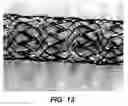 Fig. 12 - Bidirectional stent and method of use thereof