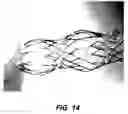 Fig. 14 - Bidirectional stent and method of use thereof