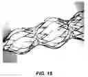 Fig. 15 - Bidirectional stent and method of use thereof