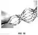 Fig. 16 - Bidirectional stent and method of use thereof