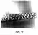 Fig. 17 - Bidirectional stent and method of use thereof