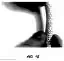 Fig. 18 - Bidirectional stent and method of use thereof