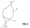 Fig. 04 - METHODS AND DEVICES FOR DELIVERING OR DELAYING LIPIDS WITHIN A DUODENUM