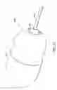 Fig. 57 - Intragastric device