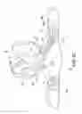 Fig. 16 - Spinal orthosis