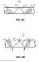 Fig. 03 - Devices and methods for pressure-responsive reshaping of blood vessels