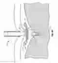 Fig. 05 - Devices and methods for pressure-responsive reshaping of blood vessels