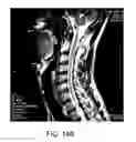 Fig. 09 - Method and apparatus for mandibular support