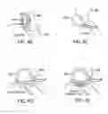 Fig. 06 - Apparatus and method for securing ocular tissue