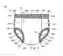 Fig. 05 - Absorbent Article Indicating Improper Fit