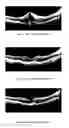 Fig. 07 - METHOD OF TREATING CONDITIONS OF THE EYE WITH AN ANTI-VEGF DARPIN