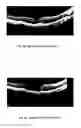 Fig. 08 - METHOD OF TREATING CONDITIONS OF THE EYE WITH AN ANTI-VEGF DARPIN