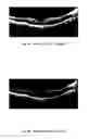 Fig. 09 - METHOD OF TREATING CONDITIONS OF THE EYE WITH AN ANTI-VEGF DARPIN