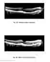 Fig. 11 - METHOD OF TREATING CONDITIONS OF THE EYE WITH AN ANTI-VEGF DARPIN