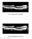 Fig. 12 - METHOD OF TREATING CONDITIONS OF THE EYE WITH AN ANTI-VEGF DARPIN