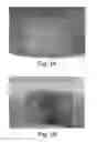 Fig. 04 - TISSUE TRANSPLANT COMPOSITIONS AND METHODS FOR USE