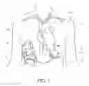 Fig. 02 - Low cost ventricular device and system thereof