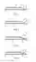 Fig. 02 - HYPODERMIC NEEDLE SYSTEM